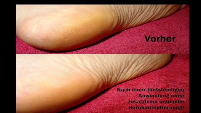 Natürliche Fußpflege Ergebnis nach einer Anwendung
